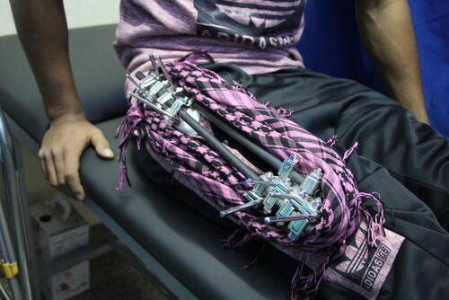 Gaza - Lifelong impact of gunshot injuries Gaza - Lifelong impact of gunshot injuries